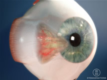 Pterygium