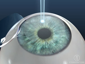 Corneal Transplant
