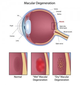 Macular Degenration Diagram