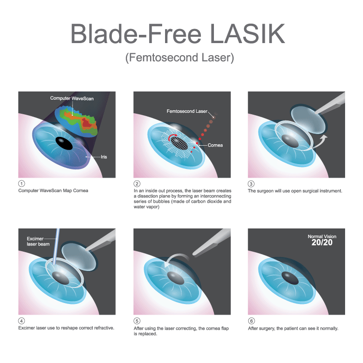 Bladeless LASIK Infographic