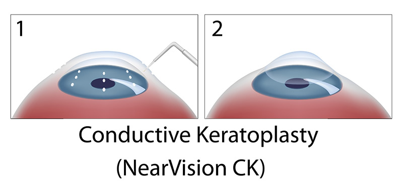 Conductive Keratoplasty Diagram