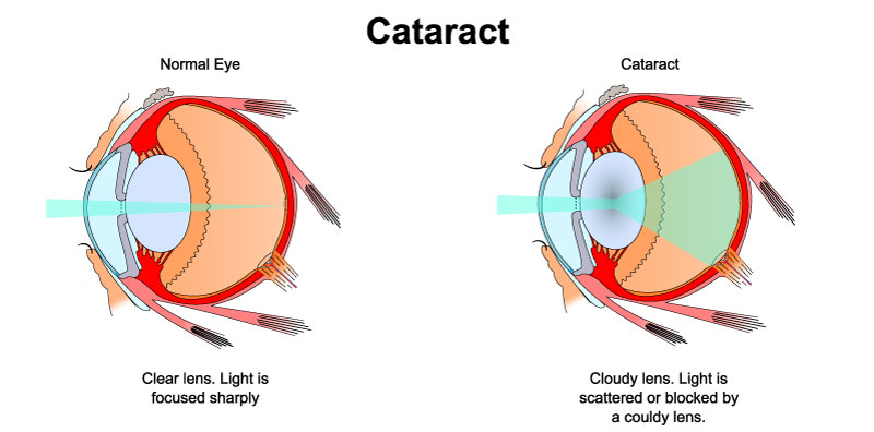 Cataracts Diagram