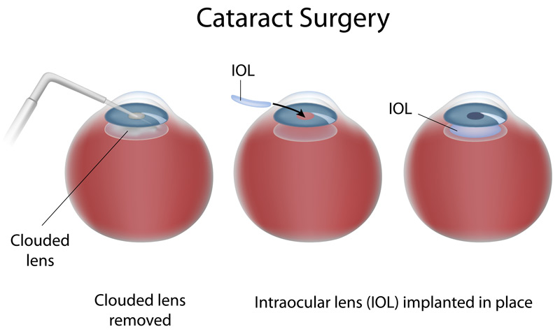 Cataracts Surgery Diagram