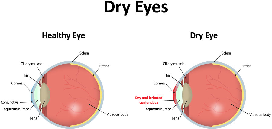 Diagram of a healthy eye compared to a dry eye