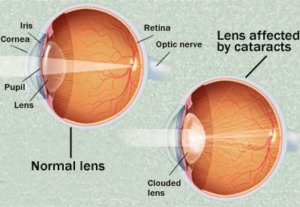 Cross section of an eye depicting a lens affected by cataracts