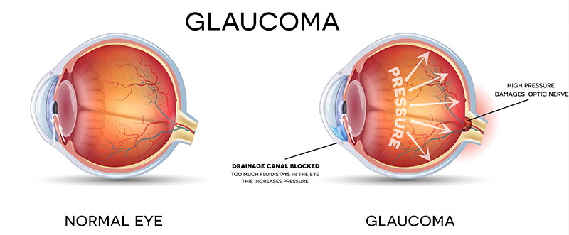 Diagram comparing a normal eye and an eye suffering from Glaucoma