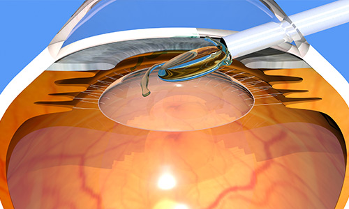 Intraocular lens implant procedure