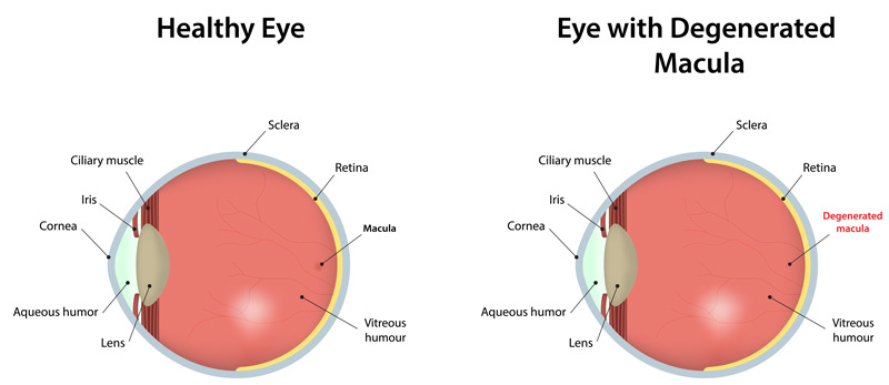Diagram Comparing a Healthy Eye and an Eye With Degenerated Macula