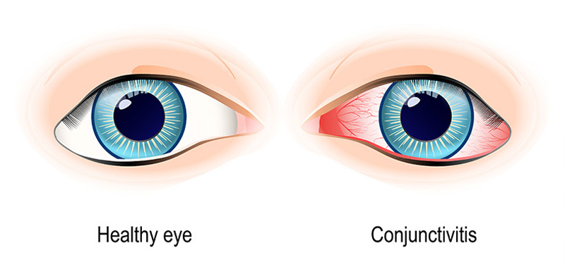 Diagram showing Conjunctivitis or Pink Eye Versus a Healthy Eye