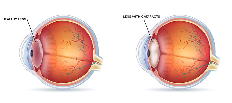 Cataracts Comparison Diagram