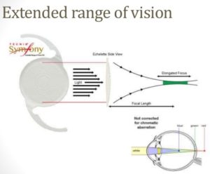 Tecnis Symfony extended range of vision intraocular lens specifications
