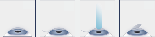 Stages of the LASIK Eye Surgery Procedure