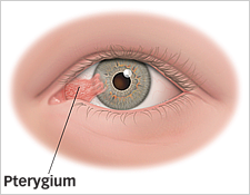 Pterygium Diagram