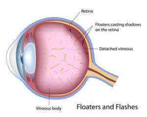 Eye Floaterscand Flashes Diagram